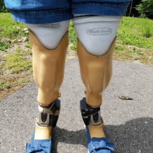 prosthetic legs, living with amputations