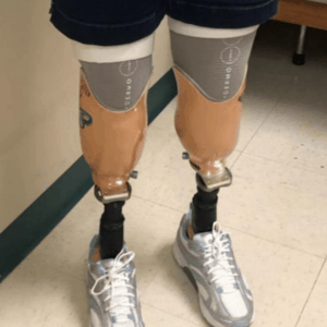 Double Above Knee Amputee