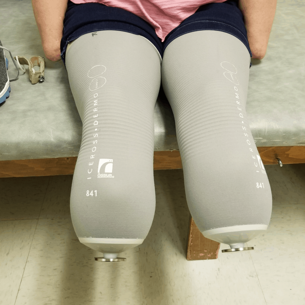 Life After Leg Amputation: 5 Things To Know About Prosthetic Legs