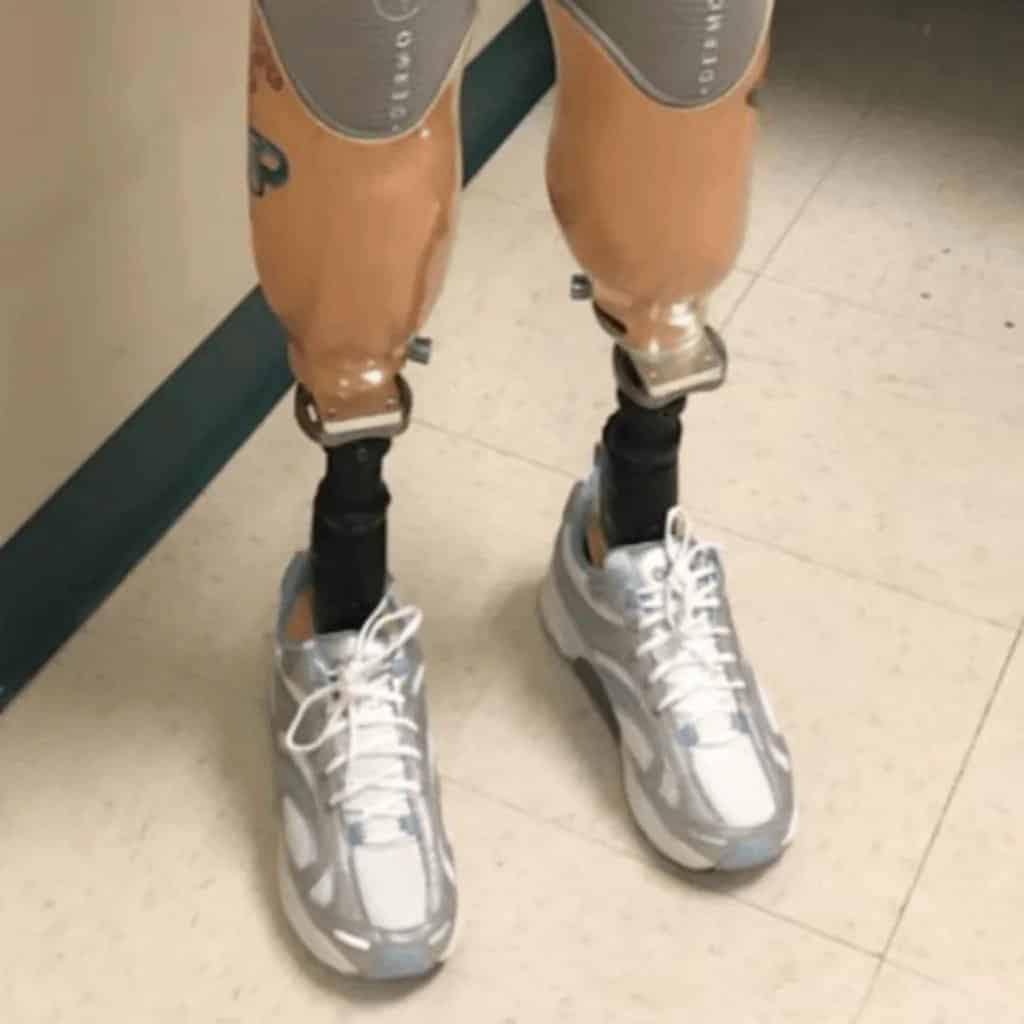front view of prosthetic legs